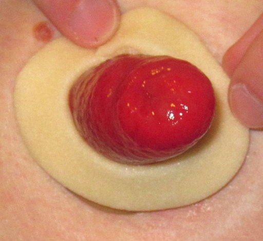 I place my Eakin barrier ring over the Duoderm. You can see the Duoderm peeking out in this photo.