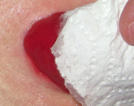 When I don't protect the skin underneath the area where my stoma flops over, I get a strip of irritation.