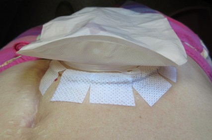 All pouched up with no mess at all. For those who are wondering about the tape job, I love Convatec wafers but the tape irritates my skin. I cut it off and add my own strips of Medipore tape.